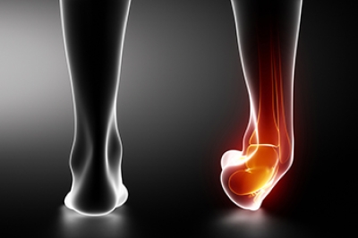 Managing Ankle Sprains